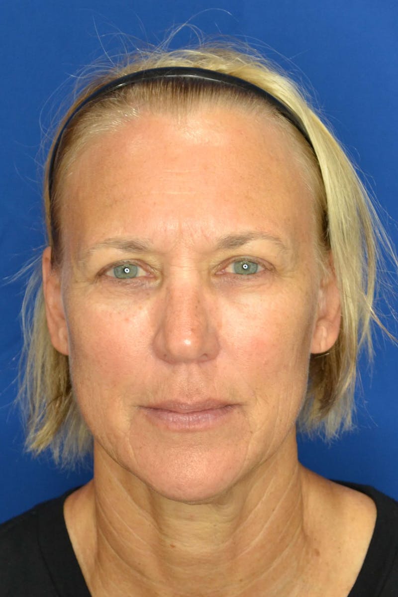 Skin Rejuvenation Before & After Gallery - Patient 119279076 - Image 1