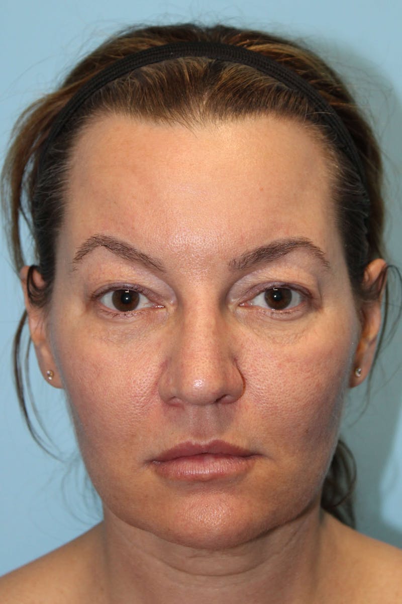 Eyelid Surgery Before & After Gallery - Patient 119278781 - Image 1