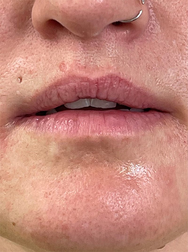 Restylane<sup>®</sup> Before & After Gallery - Patient 177056577 - Image 1