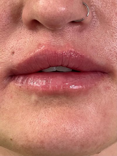 Restylane<sup>®</sup> Before & After Gallery - Patient 177056577 - Image 2