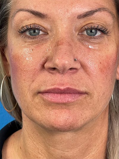 Restylane<sup>®</sup> Before & After Gallery - Patient 177056580 - Image 1