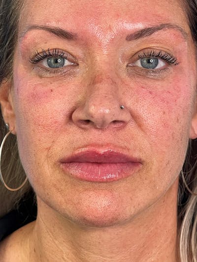 Restylane<sup>®</sup> Before & After Gallery - Patient 177056580 - Image 2