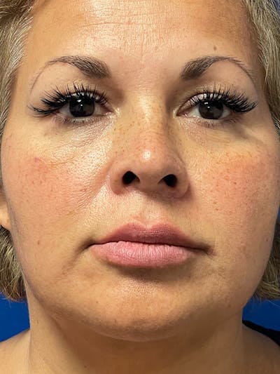Restylane<sup>®</sup> Before & After Gallery - Patient 177056583 - Image 1