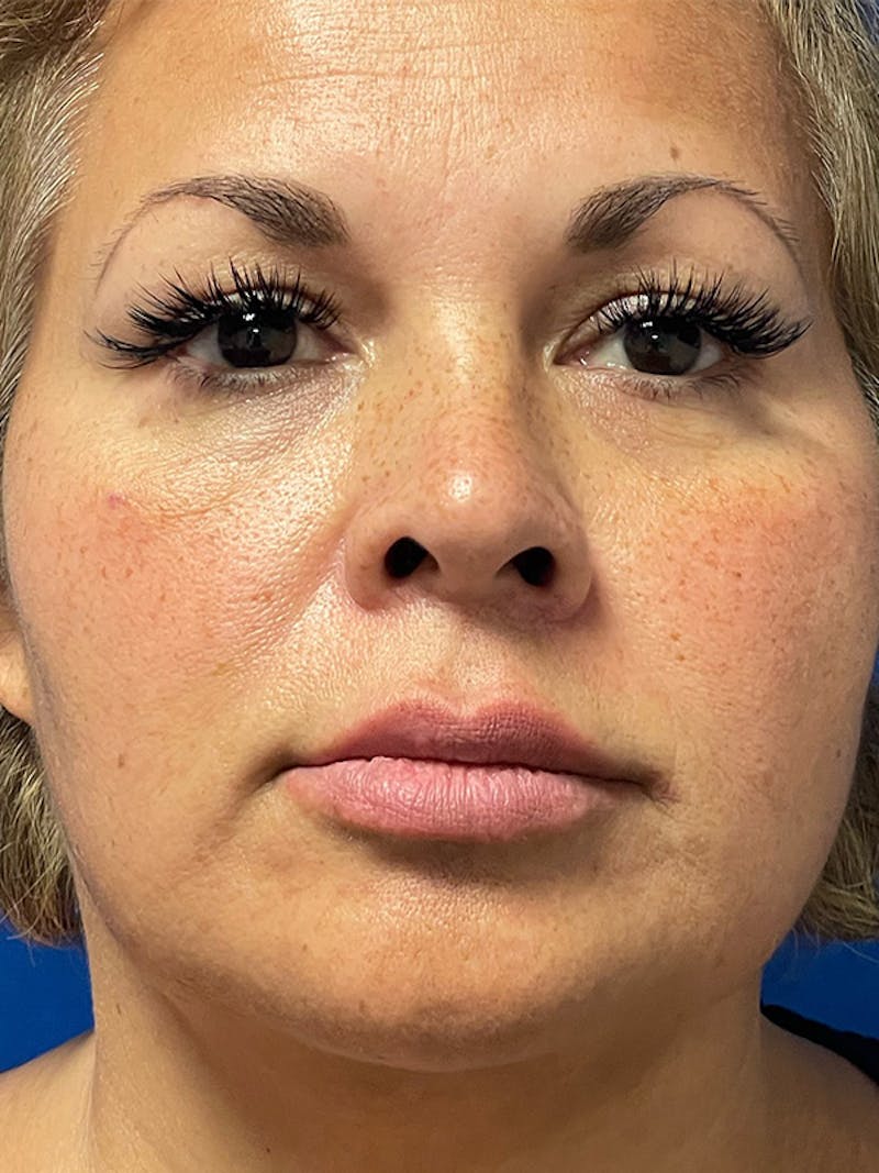 Restylane<sup>®</sup> Before & After Gallery - Patient 177056583 - Image 1