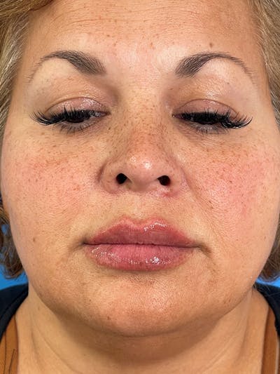 Restylane<sup>®</sup> Before & After Gallery - Patient 177056583 - Image 2