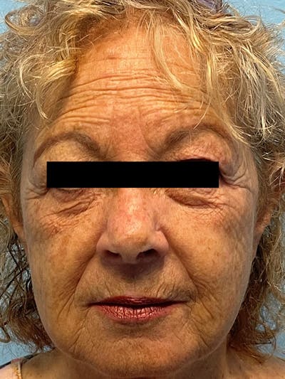 Restylane<sup>®</sup> Before & After Gallery - Patient 177061082 - Image 1