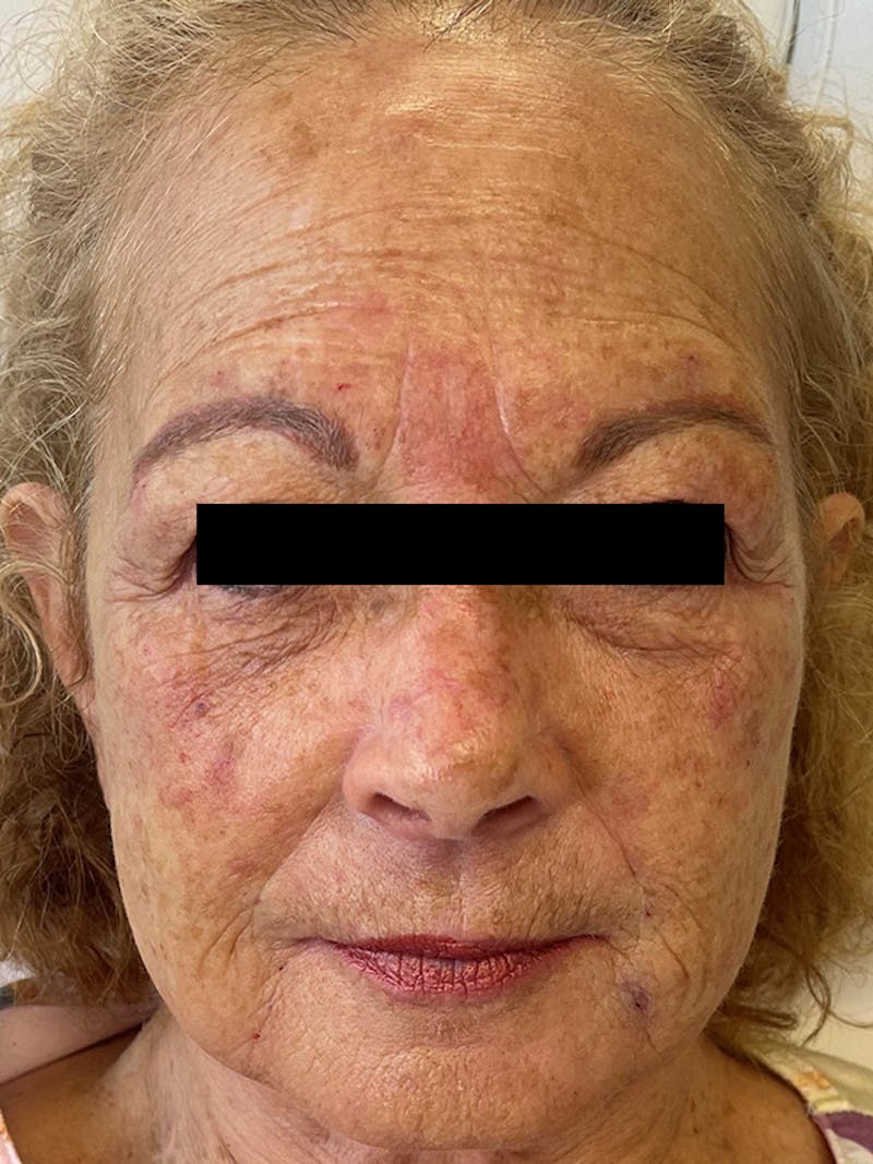 Restylane<sup>®</sup> Before & After Gallery - Patient 177061082 - Image 2