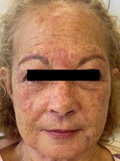 Restylane<sup>®</sup> Before & After Gallery - Patient 177061082 - Image 2