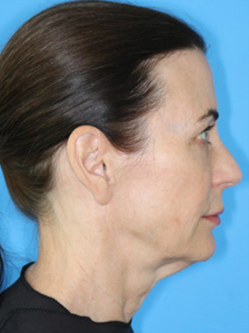 Deep Plane Lower Face and Neck Lift Before & After Gallery - Patient 177269663 - Image 5