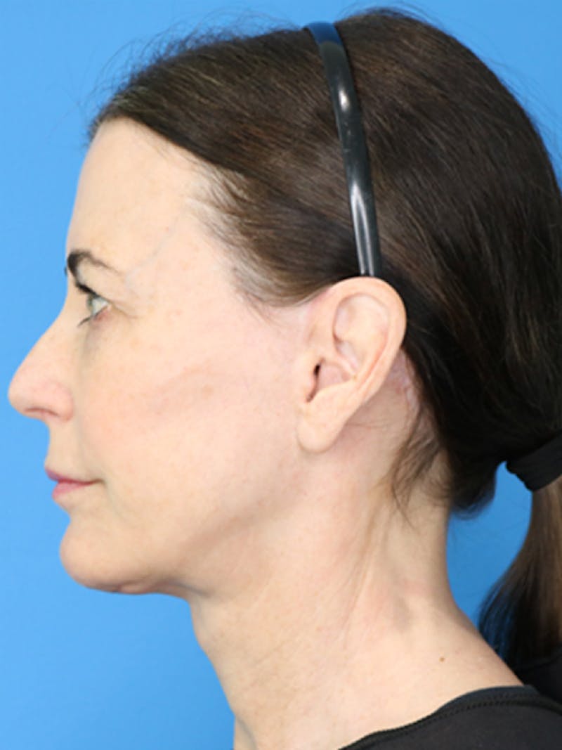 Deep Plane Lower Face and Neck Lift Before & After Gallery - Patient 177269663 - Image 4