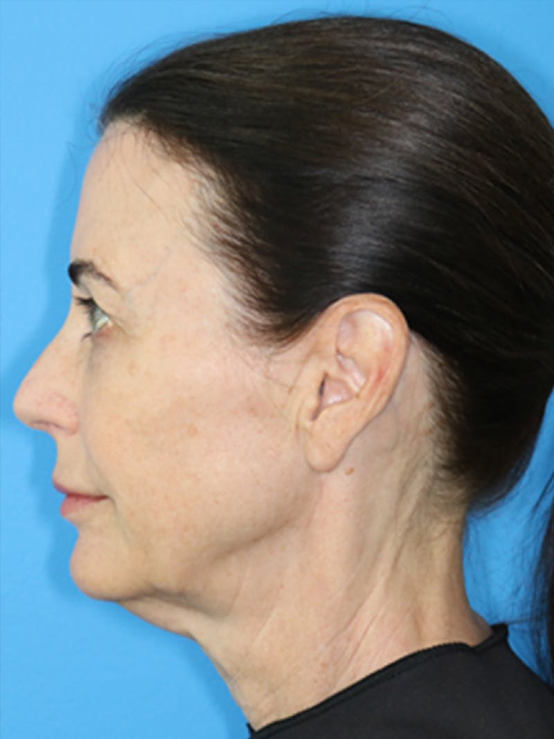 Deep Plane Lower Face and Neck Lift Before & After Gallery - Patient 177269663 - Image 3