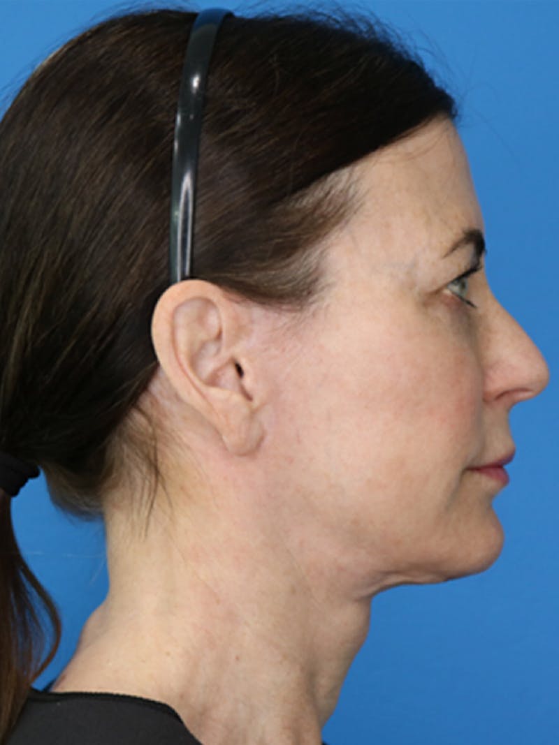 Deep Plane Lower Face and Neck Lift Before & After Gallery - Patient 177269663 - Image 6