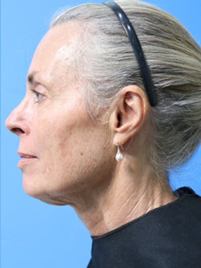 Deep Plane Lower Face and Neck Lift Before & After Gallery - Patient 177269668 - Image 1