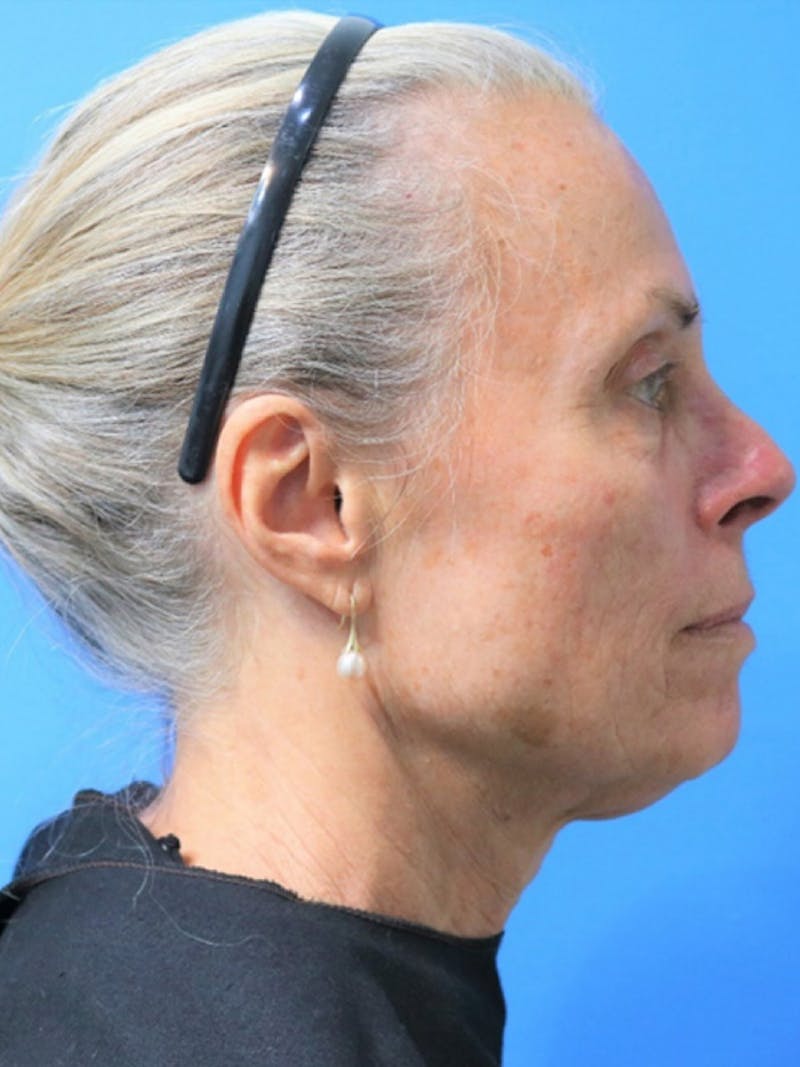 Deep Plane Lower Face and Neck Lift Before & After Gallery - Patient 177269668 - Image 3