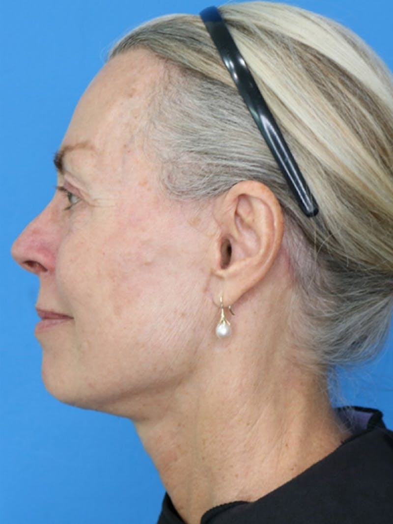 Deep Plane Lower Face and Neck Lift Before & After Gallery - Patient 177269668 - Image 2