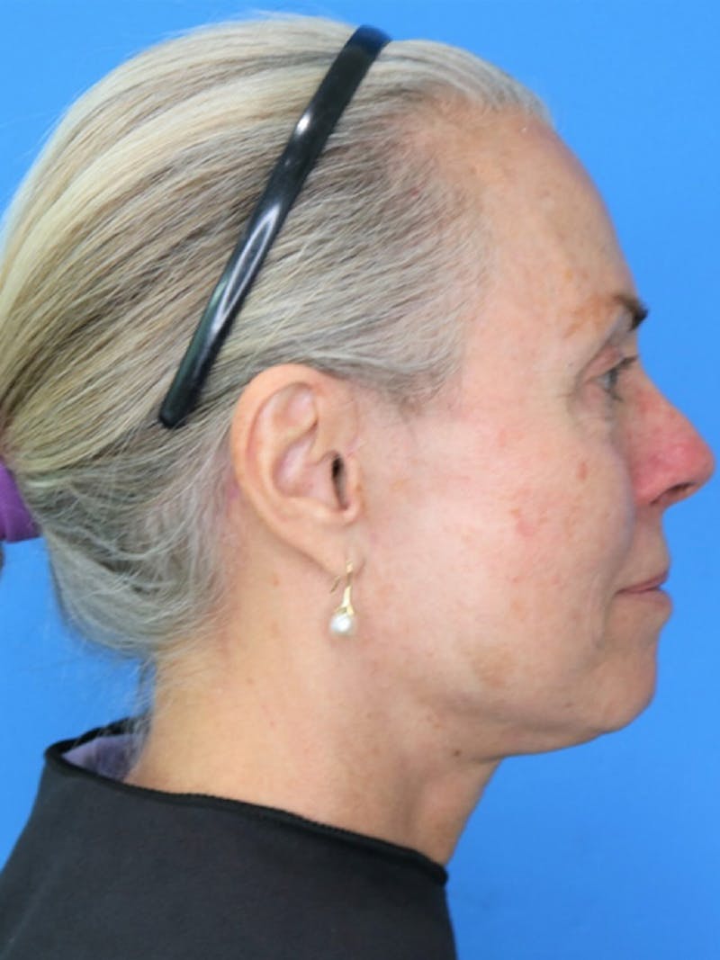 Deep Plane Lower Face and Neck Lift Before & After Gallery - Patient 177269668 - Image 4