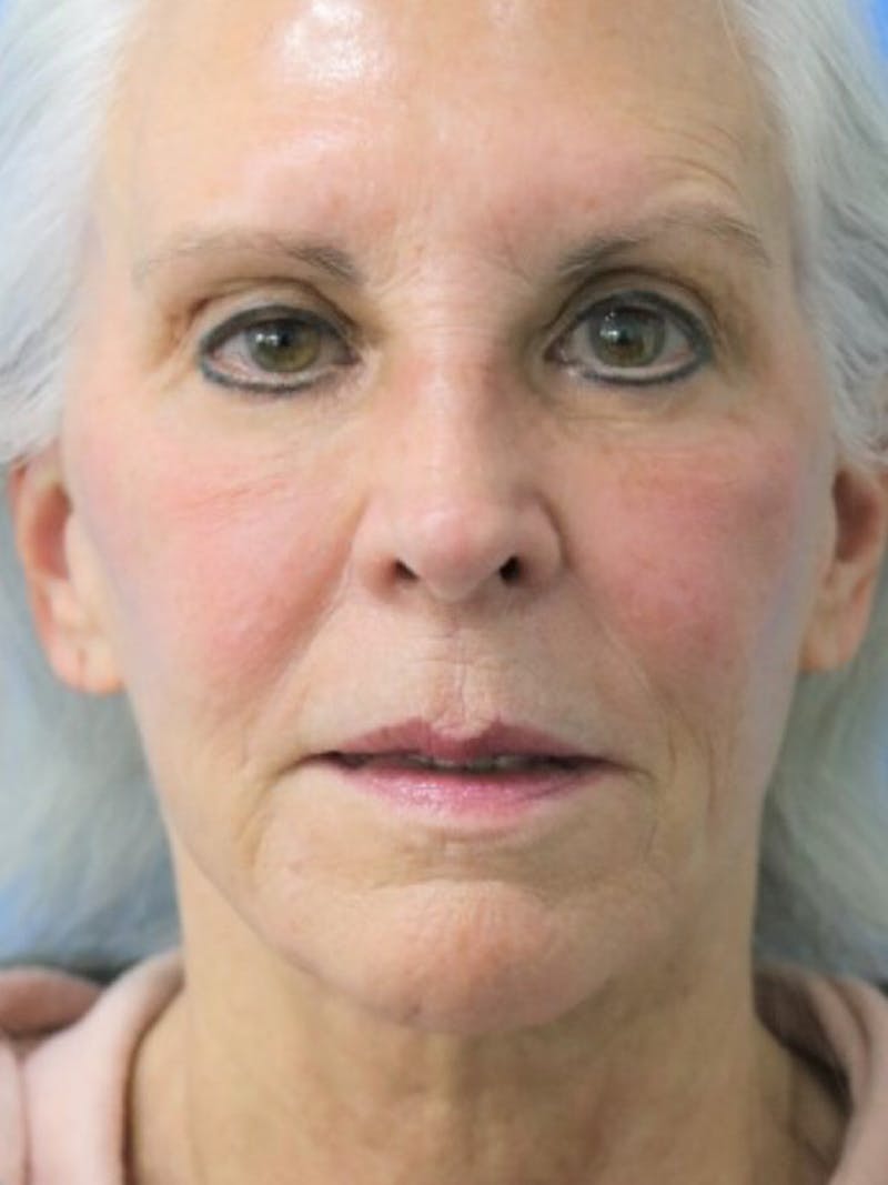 Deep Plane Lower Face and Neck Lift Before & After Gallery - Patient 177269667 - Image 1