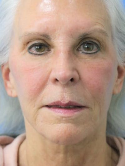 Deep Plane Lower Face and Neck Lift Before & After Gallery - Patient 177269667 - Image 1
