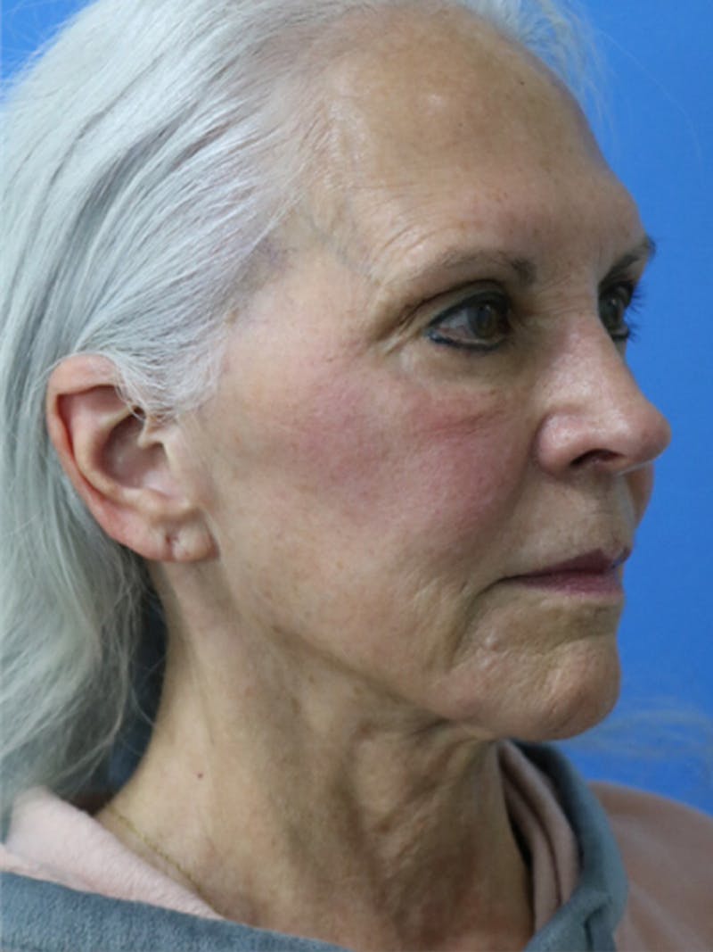 Deep Plane Lower Face and Neck Lift Before & After Gallery - Patient 177269667 - Image 3