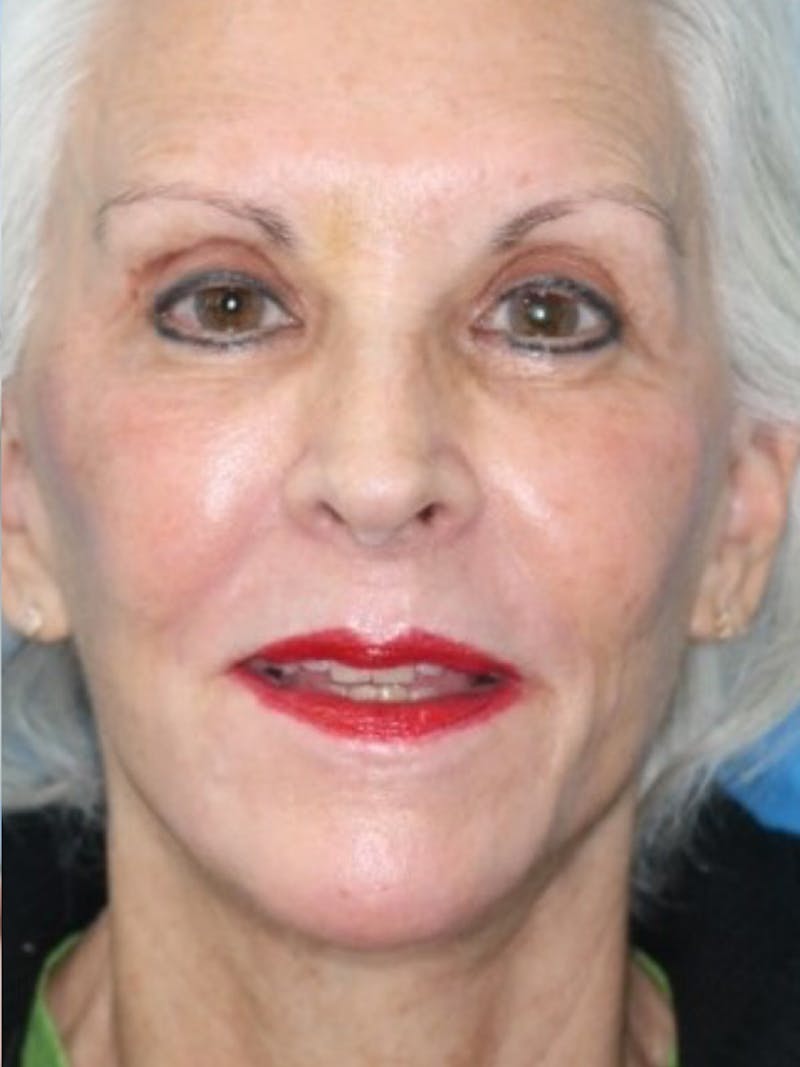 Deep Plane Lower Face and Neck Lift Before & After Gallery - Patient 177269667 - Image 2