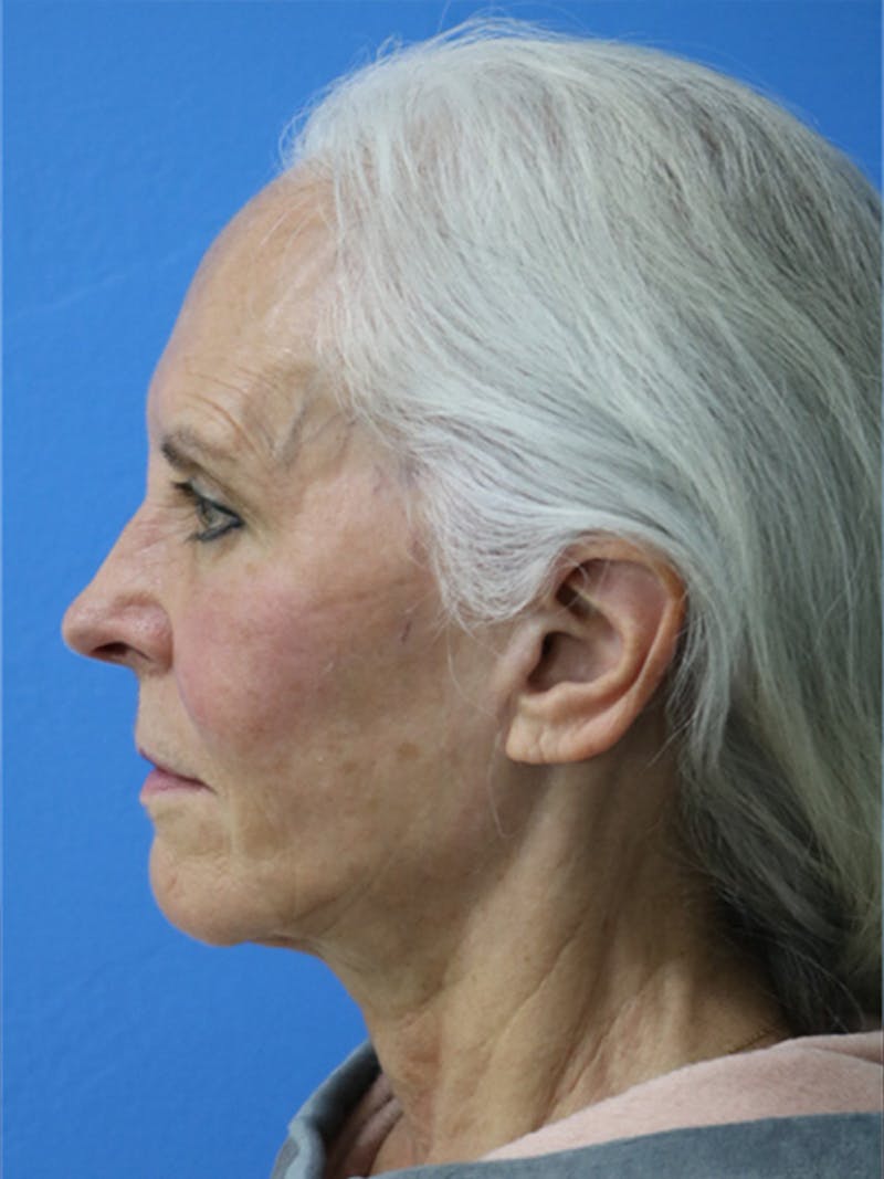 Deep Plane Lower Face and Neck Lift Before & After Gallery - Patient 177269667 - Image 5