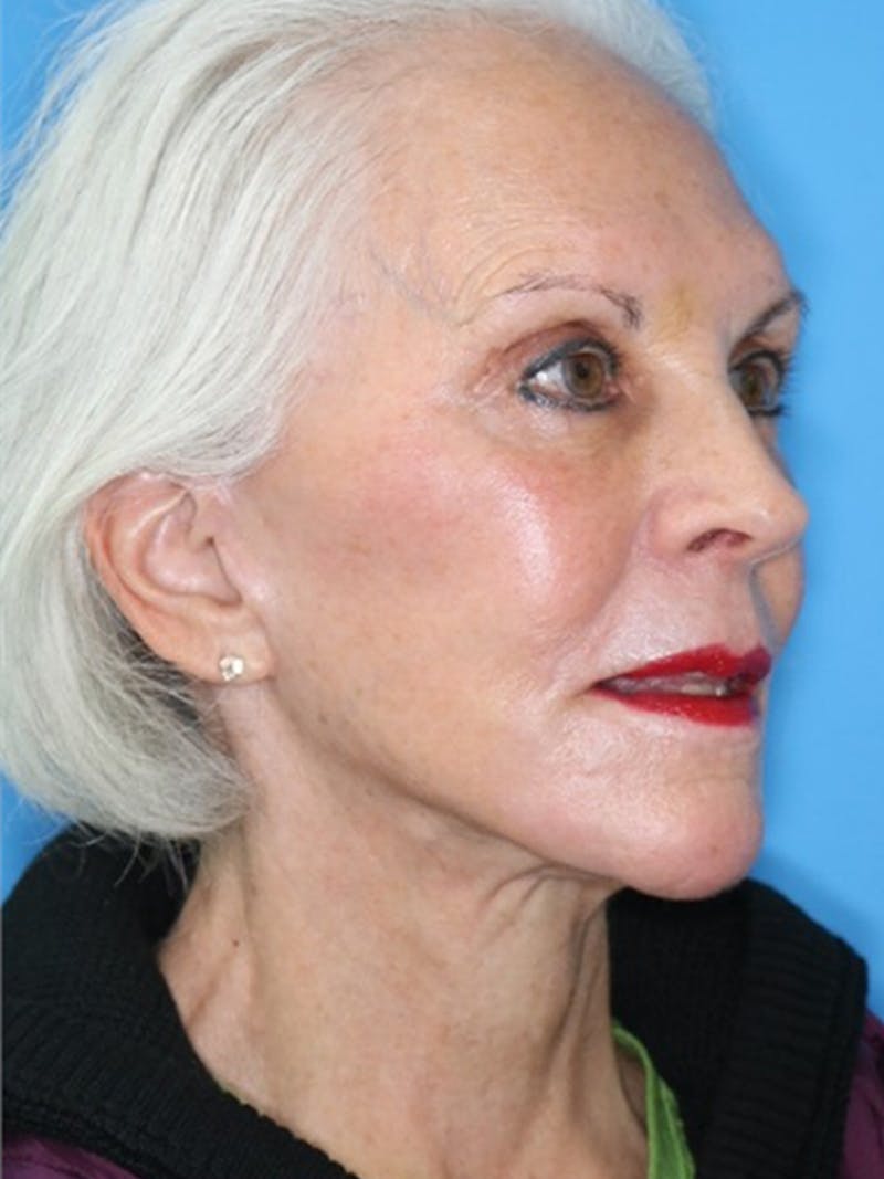 Deep Plane Lower Face and Neck Lift Before & After Gallery - Patient 177269667 - Image 4