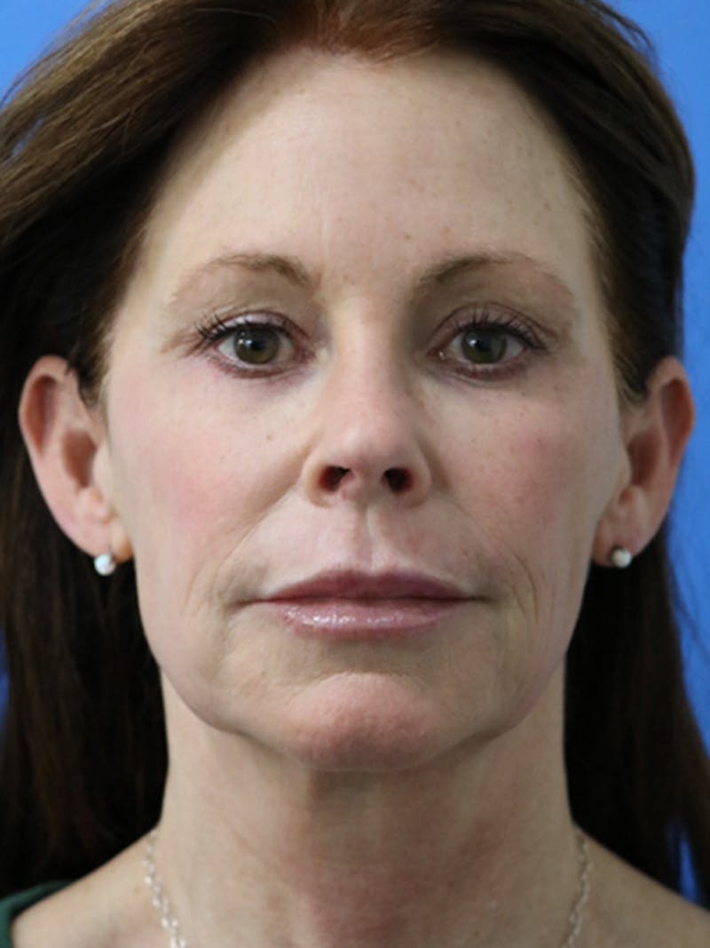 Deep Plane Lower Face and Neck Lift Before & After Gallery - Patient 177269696 - Image 1