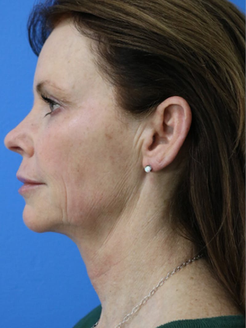 Deep Plane Lower Face and Neck Lift Before & After Gallery - Patient 177269696 - Image 5