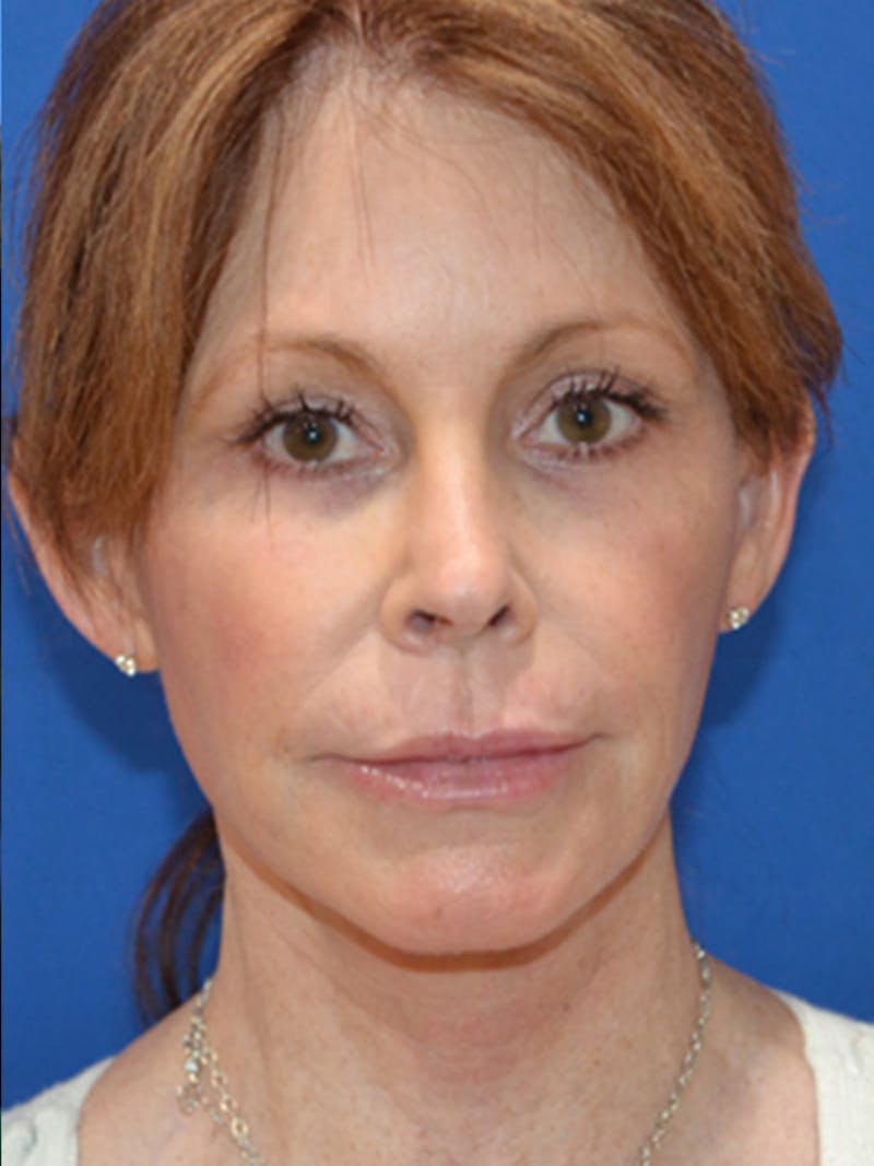 Deep Plane Lower Face and Neck Lift Before & After Gallery - Patient 177269696 - Image 2