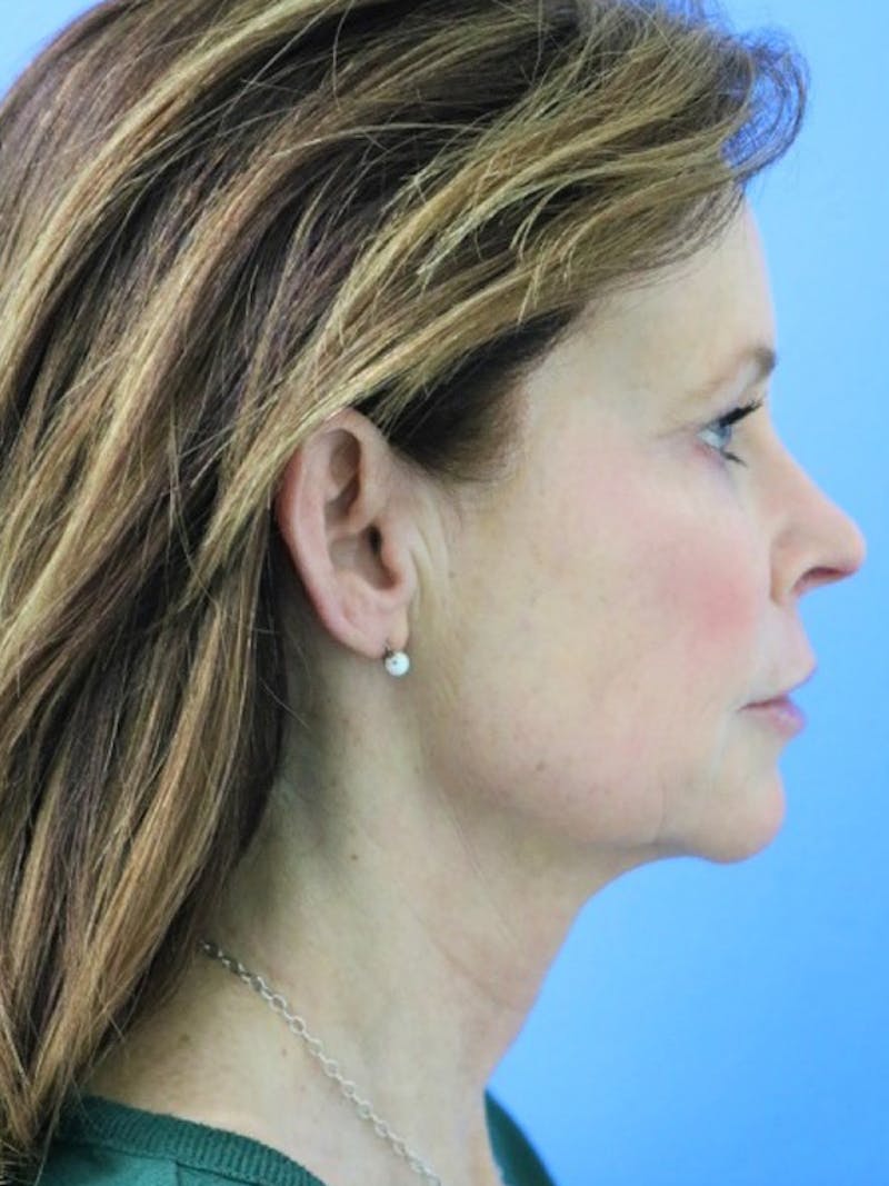 Deep Plane Lower Face and Neck Lift Before & After Gallery - Patient 177269696 - Image 3