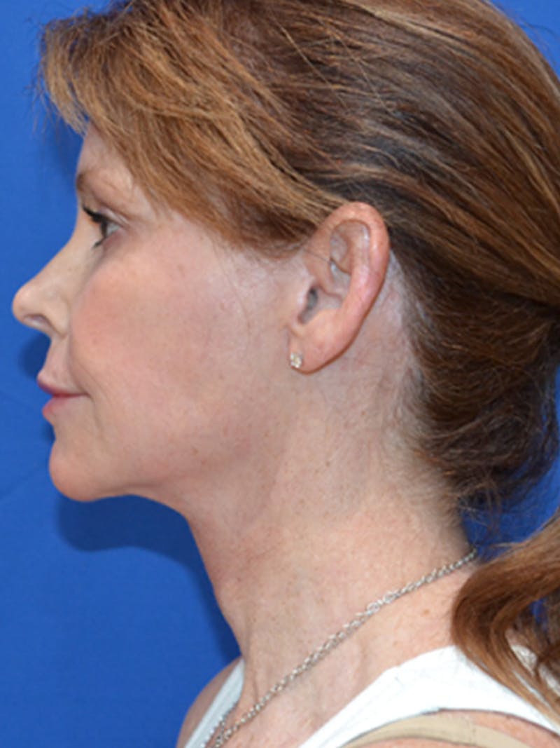 Deep Plane Lower Face and Neck Lift Before & After Gallery - Patient 177269696 - Image 6