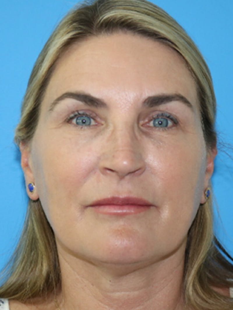 Deep Plane Lower Face and Neck Lift Before & After Gallery - Patient 177269695 - Image 1