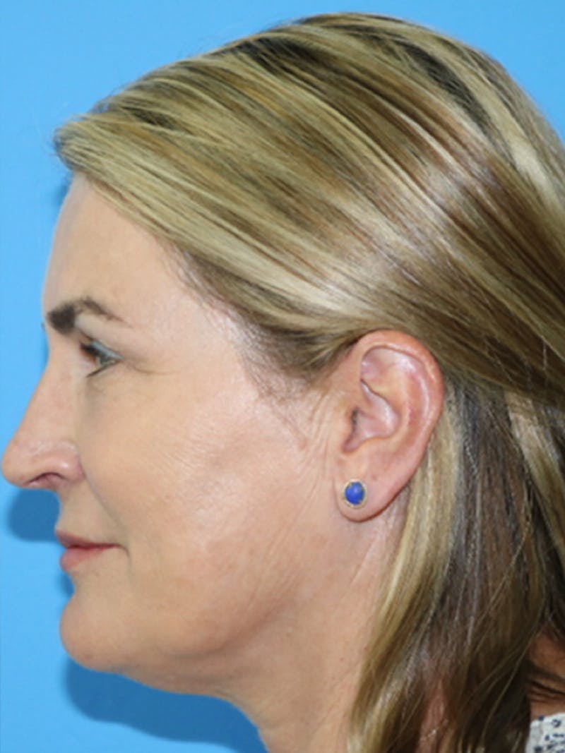 Deep Plane Lower Face and Neck Lift Before & After Gallery - Patient 177269695 - Image 3