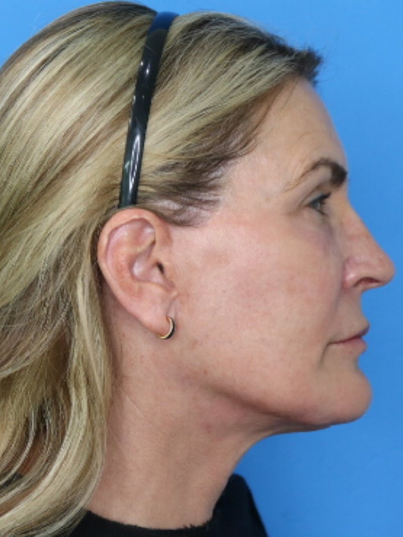 Deep Plane Lower Face and Neck Lift Before & After Gallery - Patient 177269695 - Image 6