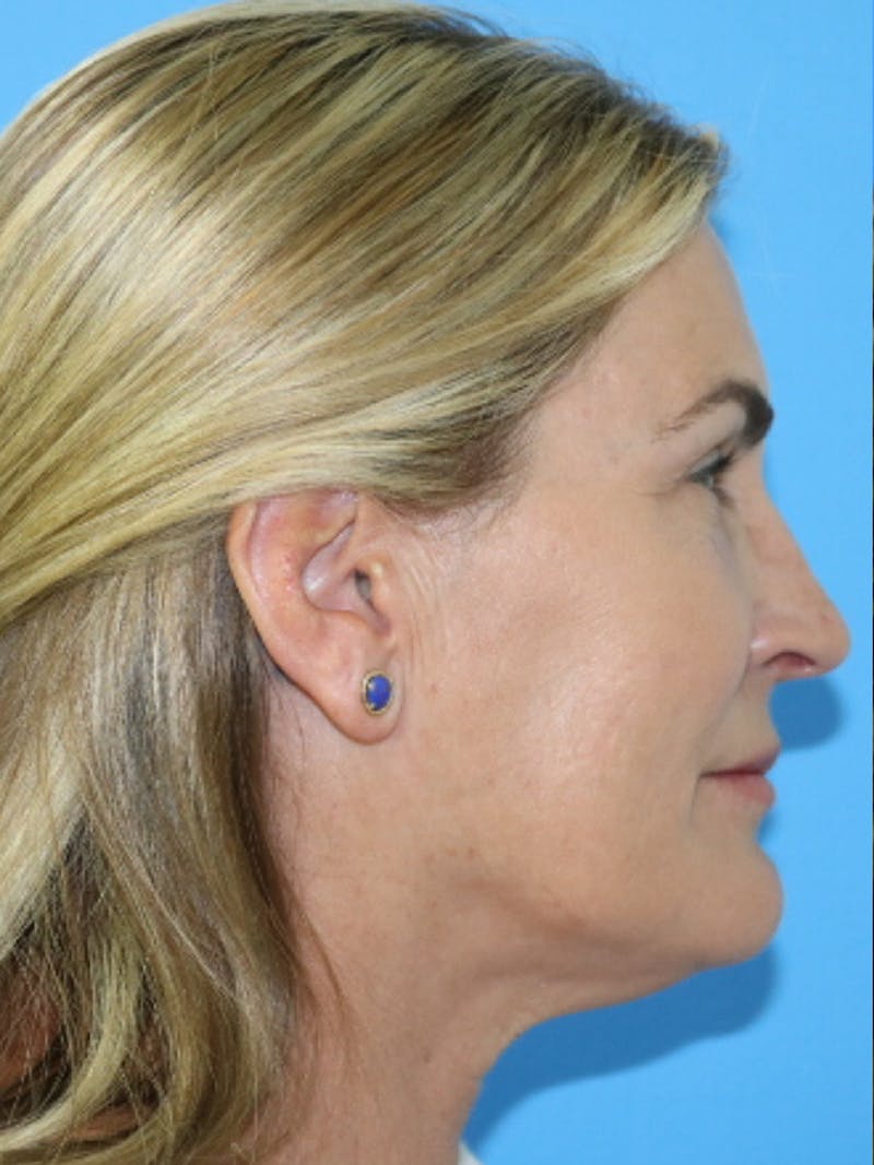 Deep Plane Lower Face and Neck Lift Before & After Gallery - Patient 177269695 - Image 5