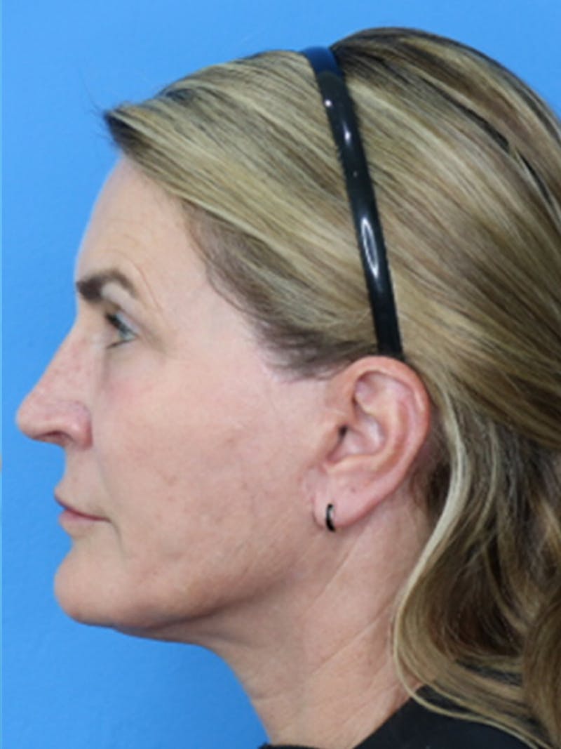 Deep Plane Lower Face and Neck Lift Before & After Gallery - Patient 177269695 - Image 4