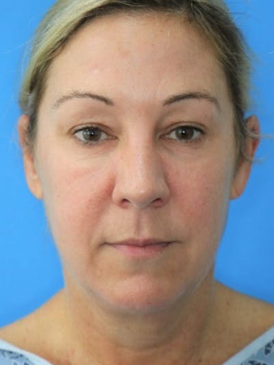 Deep Plane Lower Face and Neck Lift Before & After Gallery - Patient 177269694 - Image 1