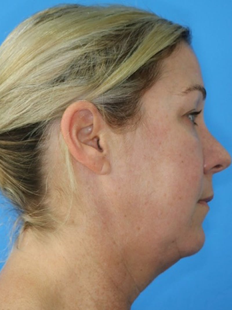 Deep Plane Lower Face and Neck Lift Before & After Gallery - Patient 177269694 - Image 5