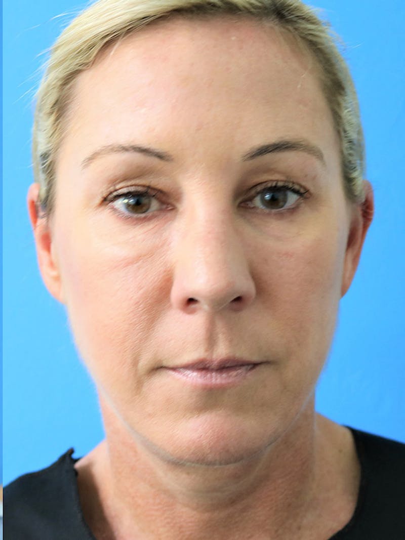Deep Plane Lower Face and Neck Lift Before & After Gallery - Patient 177269694 - Image 2