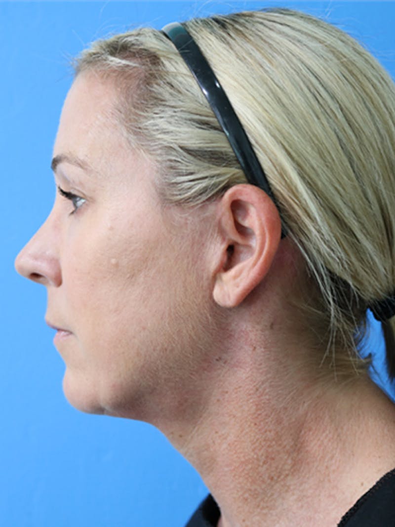 Deep Plane Lower Face and Neck Lift Before & After Gallery - Patient 177269694 - Image 4