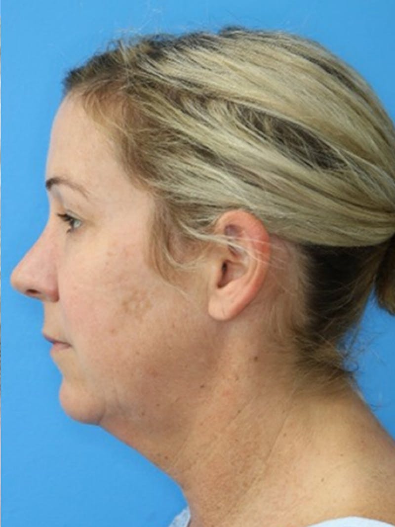 Deep Plane Lower Face and Neck Lift Before & After Gallery - Patient 177269694 - Image 3