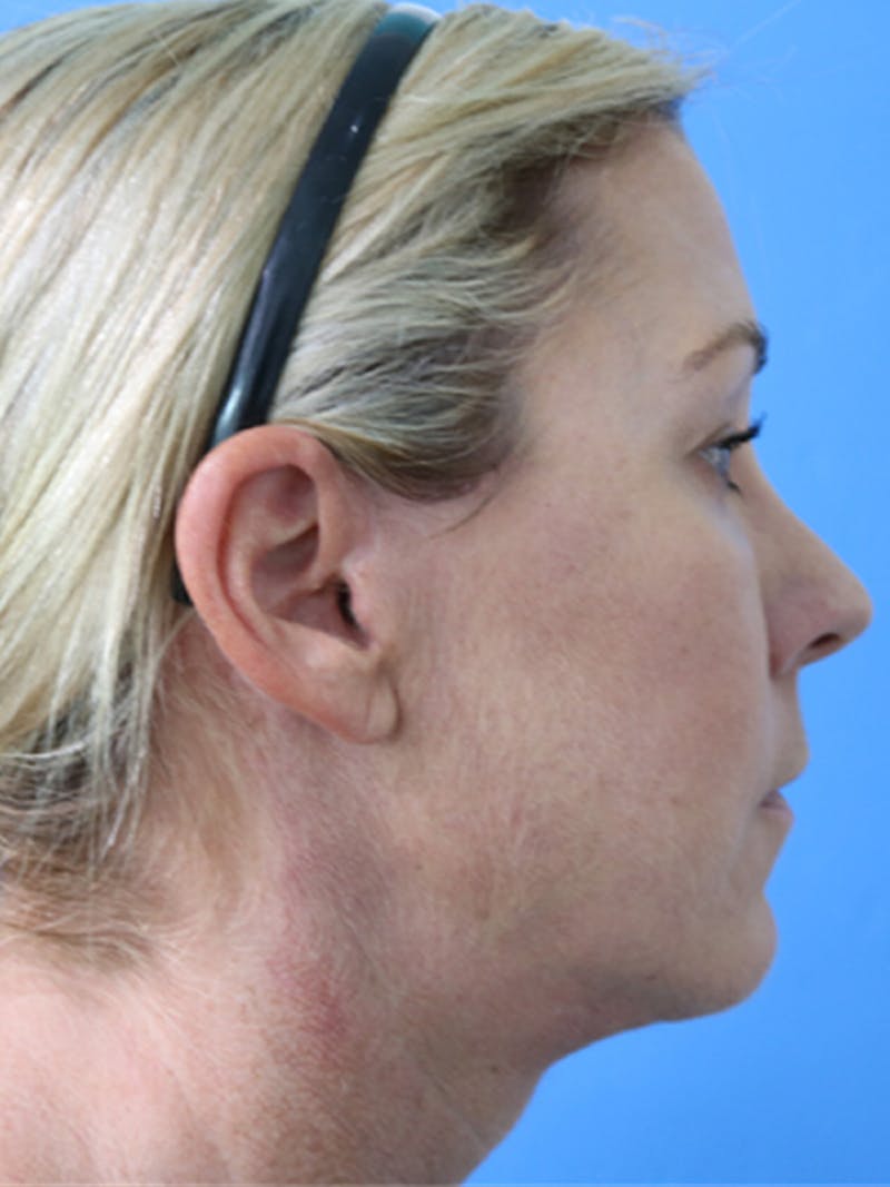 Deep Plane Lower Face and Neck Lift Before & After Gallery - Patient 177269694 - Image 6