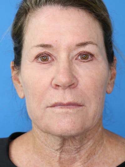 Deep Plane Lower Face and Neck Lift Before & After Gallery - Patient 177269693 - Image 1