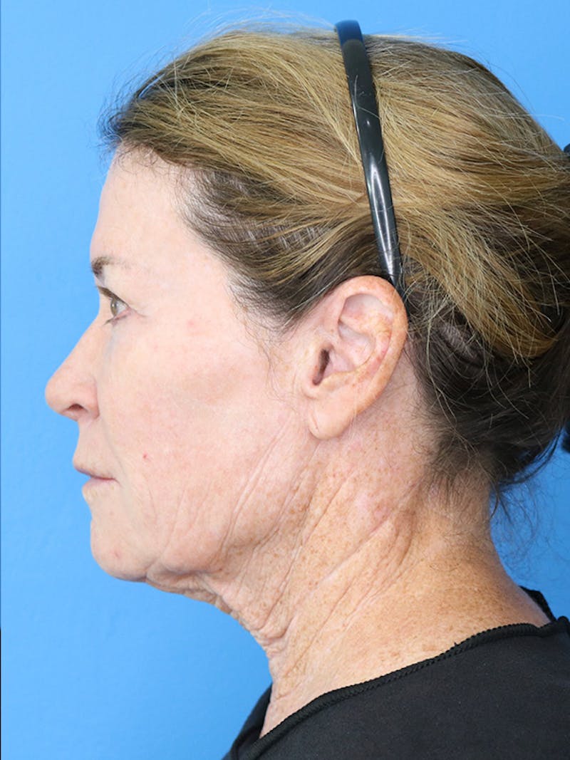 Deep Plane Lower Face and Neck Lift Before & After Gallery - Patient 177269693 - Image 5