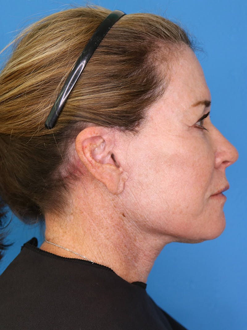 Deep Plane Lower Face and Neck Lift Before & After Gallery - Patient 177269693 - Image 4