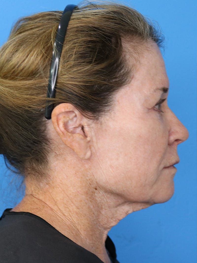 Deep Plane Lower Face and Neck Lift Before & After Gallery - Patient 177269693 - Image 3