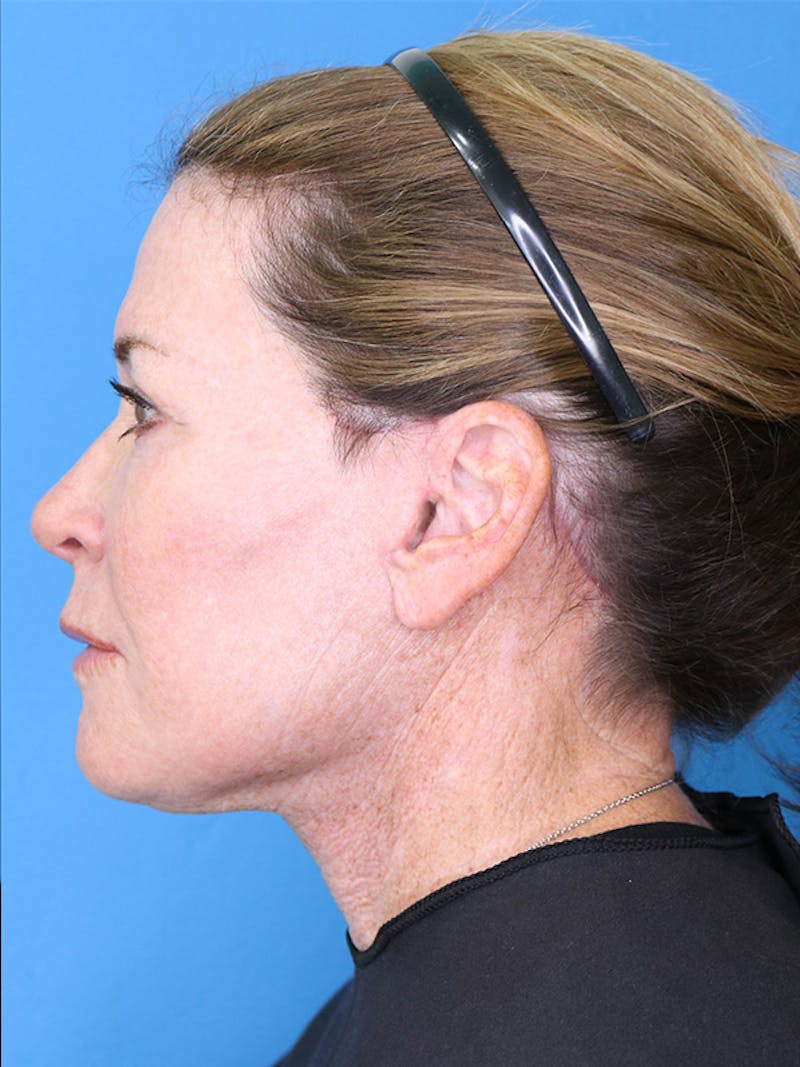 Deep Plane Lower Face and Neck Lift Before & After Gallery - Patient 177269693 - Image 6