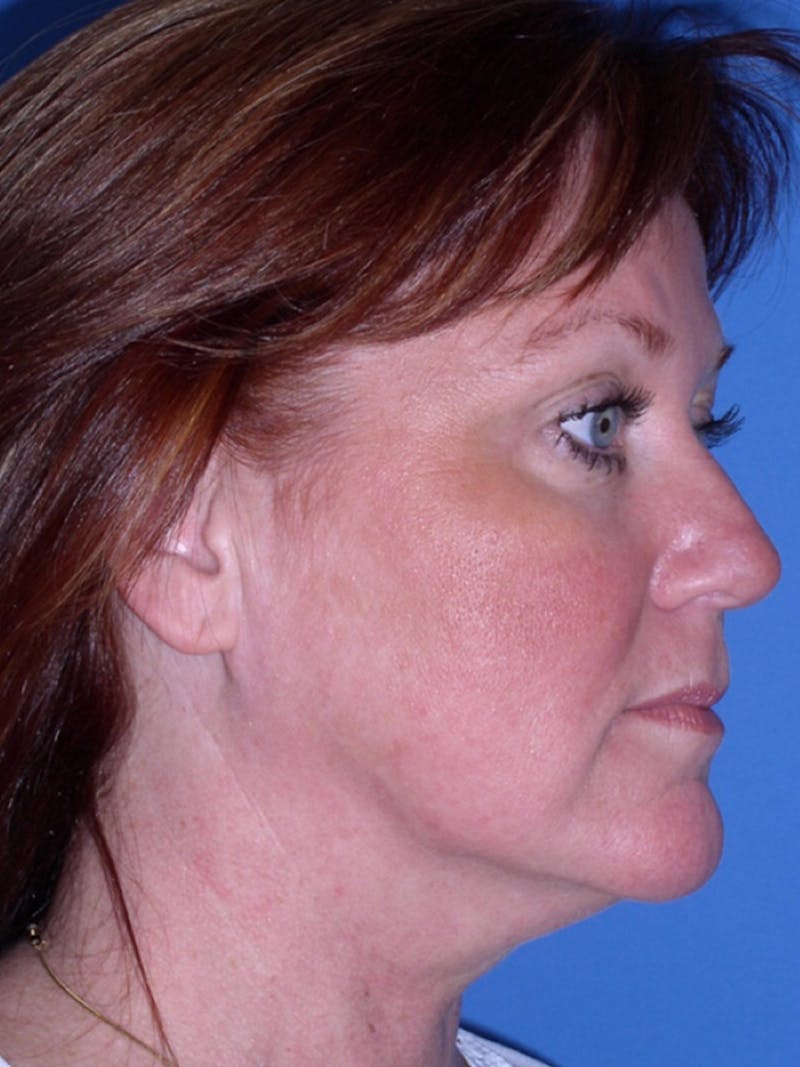 Deep Plane Lower Face and Neck Lift Before & After Gallery - Patient 177269692 - Image 3
