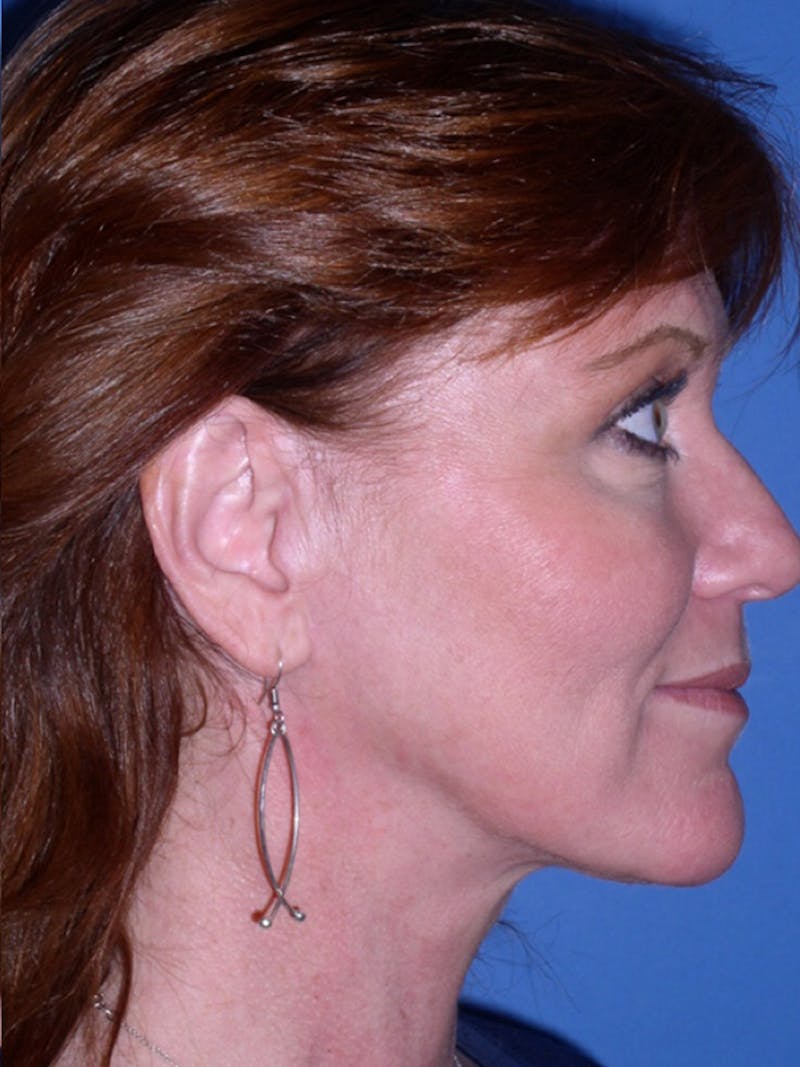 Deep Plane Lower Face and Neck Lift Before & After Gallery - Patient 177269692 - Image 6