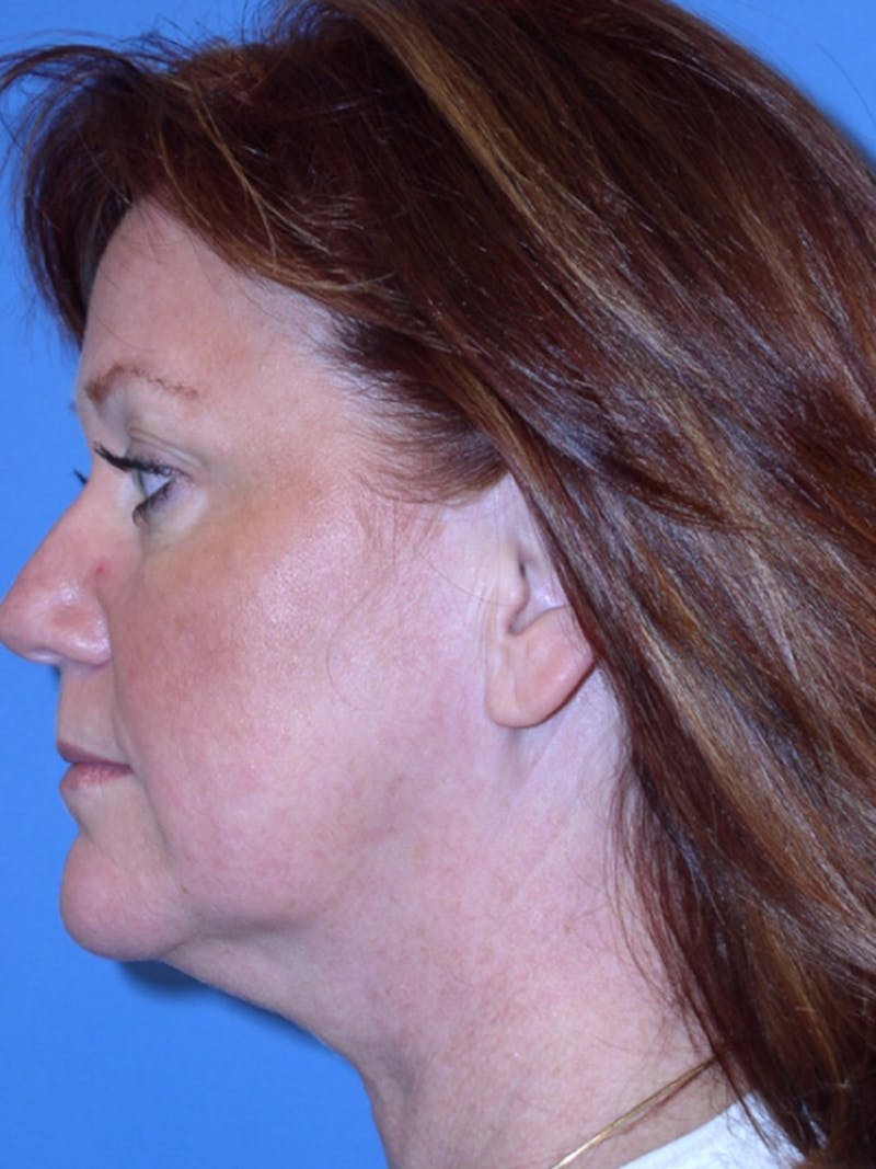 Deep Plane Lower Face and Neck Lift Before & After Gallery - Patient 177269692 - Image 7